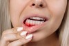 خونریزی لثه را چه زمانی باید جدی گرفت؟